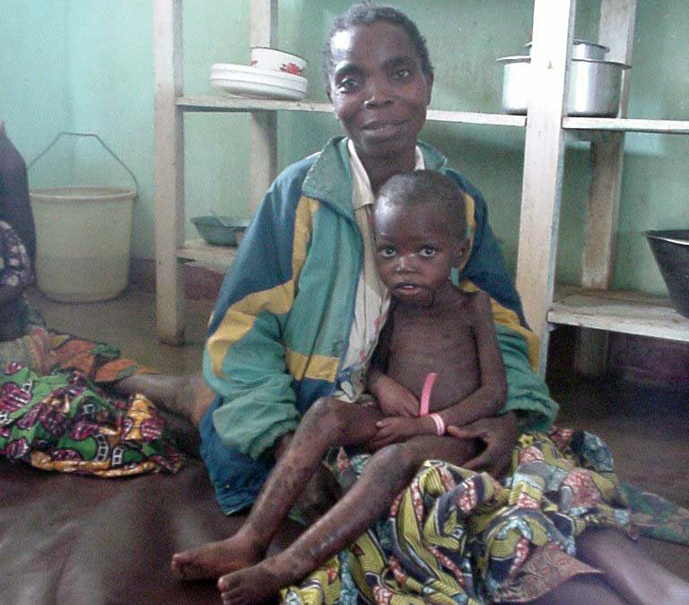 Revisiting the Evidence on Kwashiorkor Malnutrition